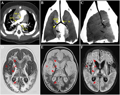 A Delayed Anatomic Diagnosis and Management Challenge in an Initially Asymptomatic Infant With Type II Pulmonary Artery Sling: A Case Report